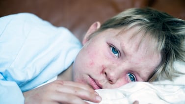 South Carolina measles outbreak surges to 211 cases after holidays