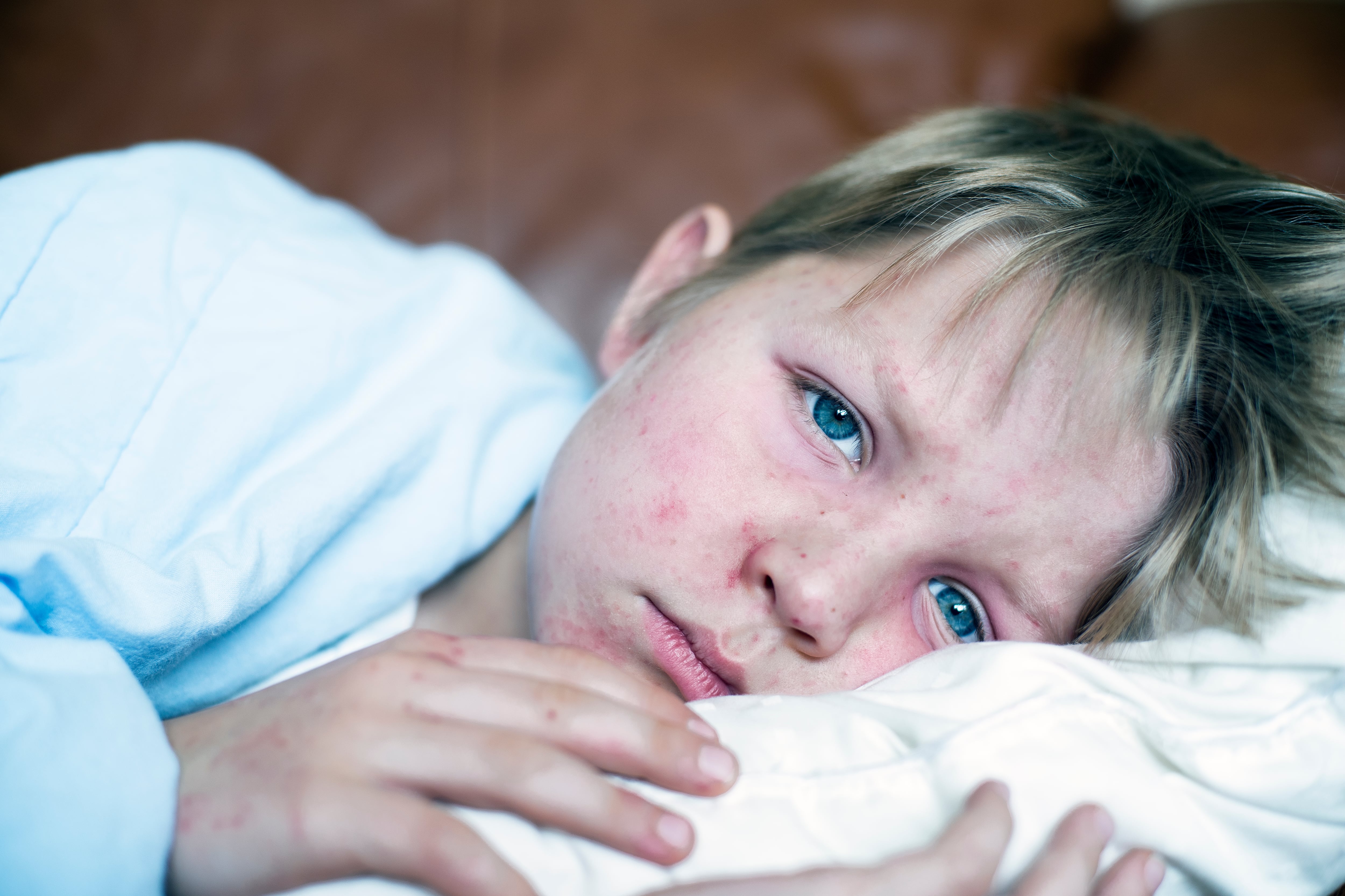 A young boy with measles lies in bed.
