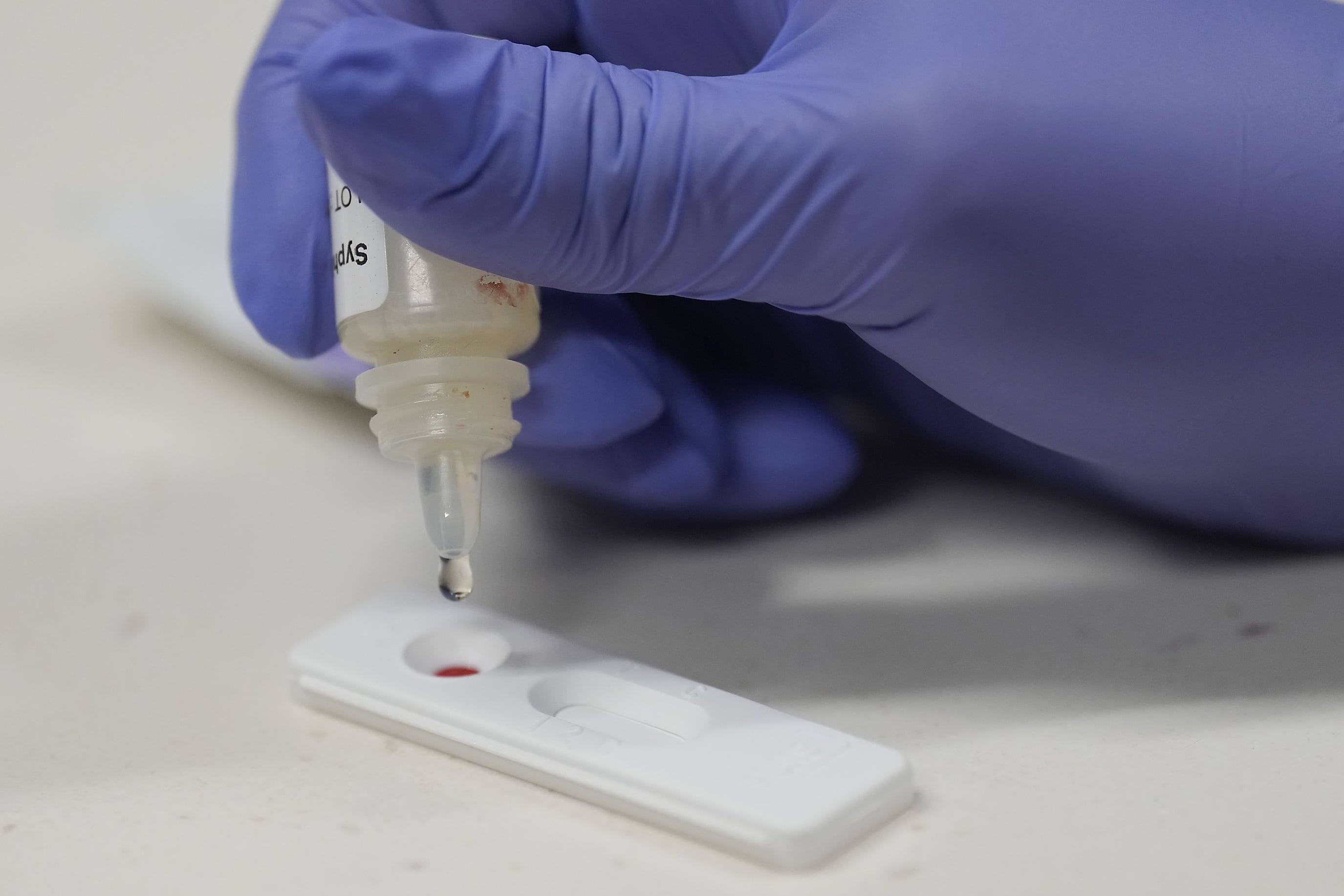 A hand wearing a latex glove conducts a rapid test for congenital syphilis.