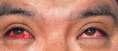 A photograph of the eyes of an infected dairy worker in Texas, with ruptured blood vessels and bleeding conjunctiva.