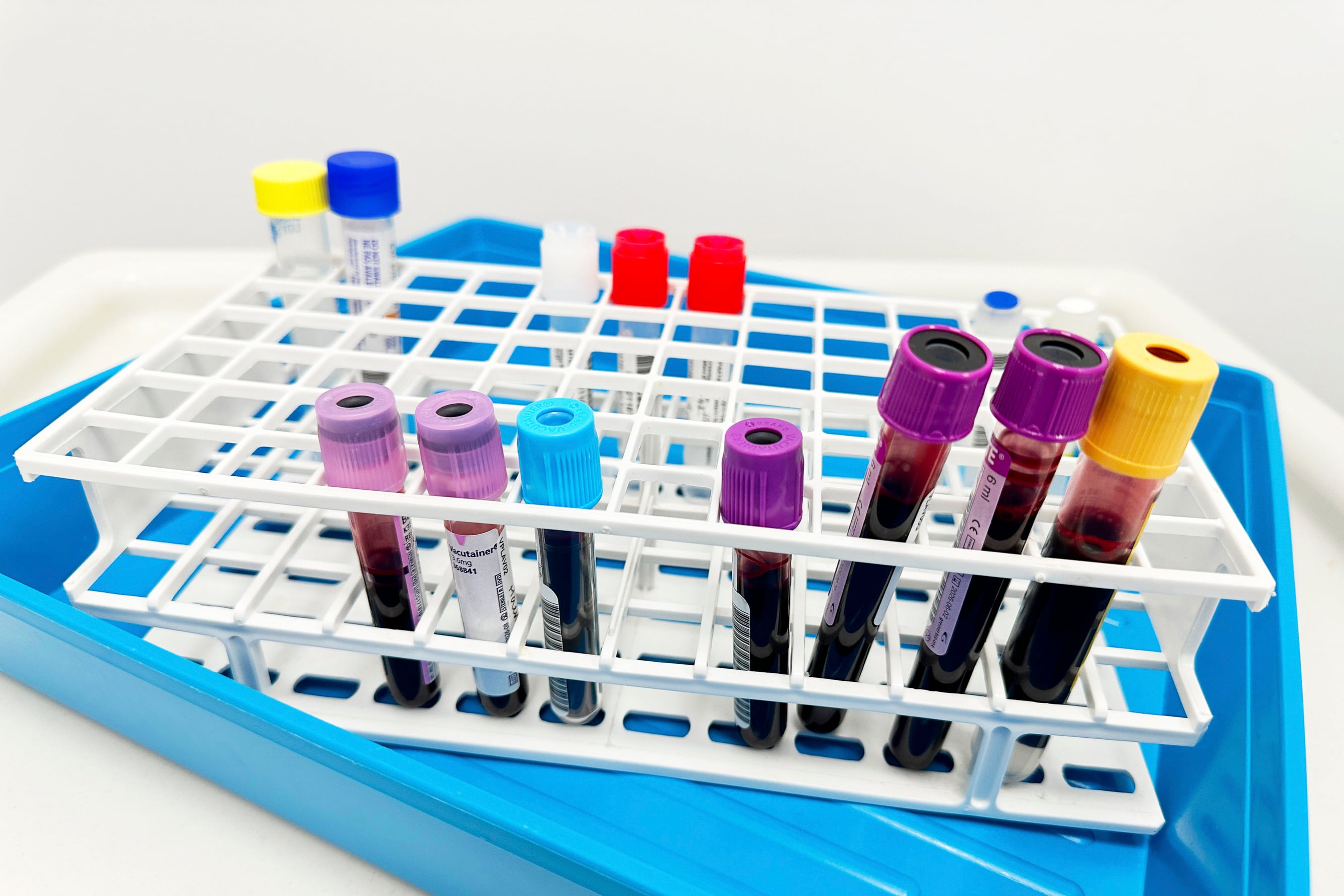 A photograph of blood samples in test tubes inside a tray.