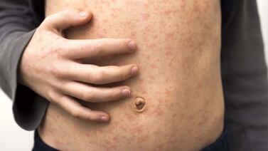 Georgia reports measles case in unvaccinated metro Atlanta patient