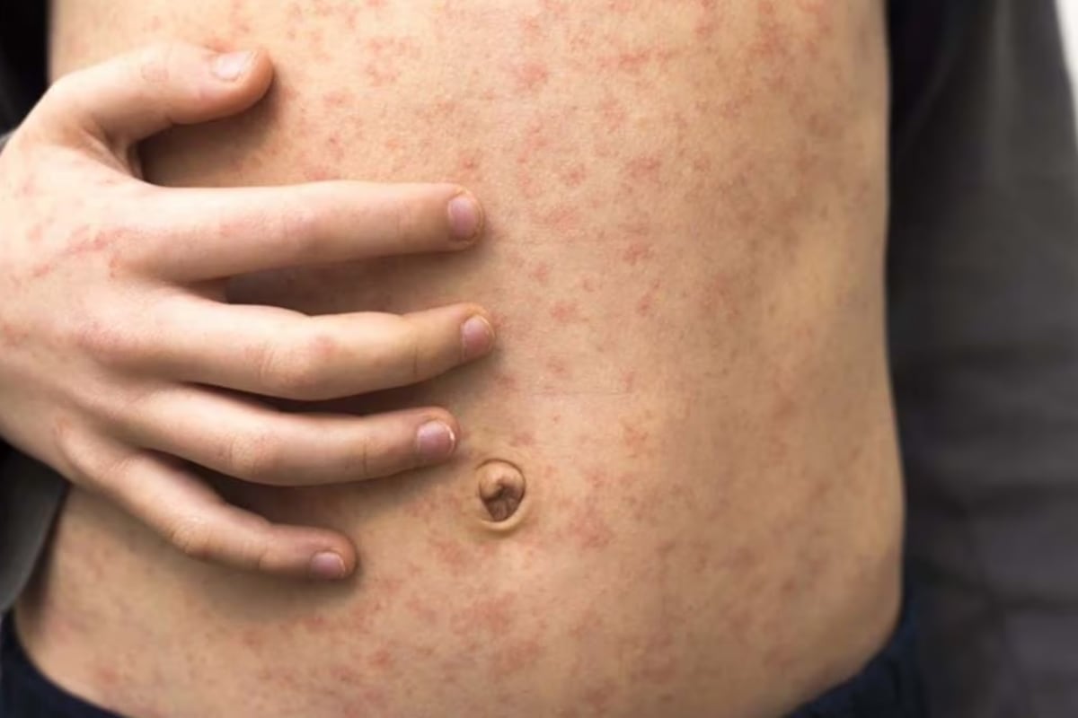 A child with measles rashes on their hand on stomach.